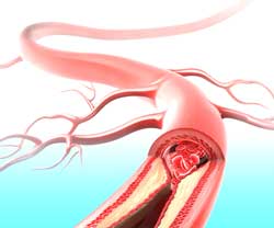 peripheral vascular disease occlusion or narrowing by atherosclerotic plaques of the arteries coronary artery disease