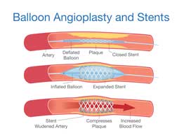 peripheral vascular disease Balloon angioplasty and stenting peripheral arterial disease PAD