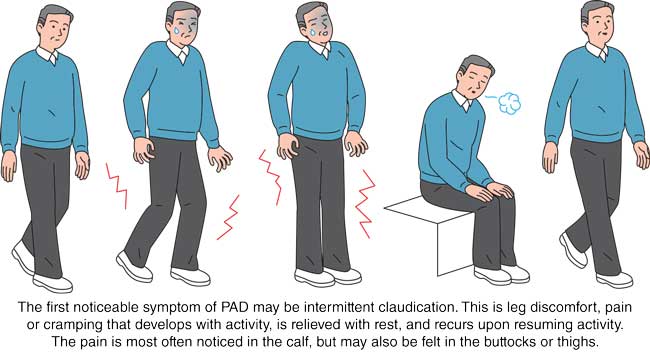 intermittent claudication coronary artery disease peripheral arterial disease