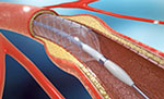 Stent